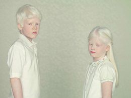 रंगहीनता-(Albinism)